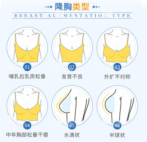 假体隆胸适应症.jpg 假体隆胸适应症.jpg