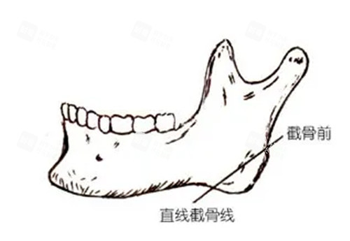 下颌角截骨简笔.jpg 下颌角截骨简笔.jpg