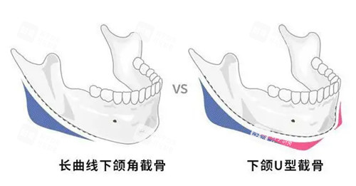 下颌角截骨位置示意图.jpg 下颌角截骨位置示意图.jpg