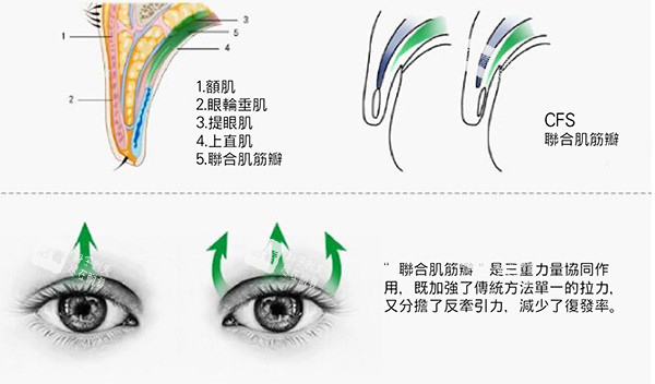 双眼皮失败修复cfs悬吊.jpg 双眼皮失败修复cfs悬吊.jpg