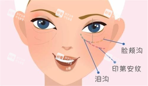 泪沟填充图.png