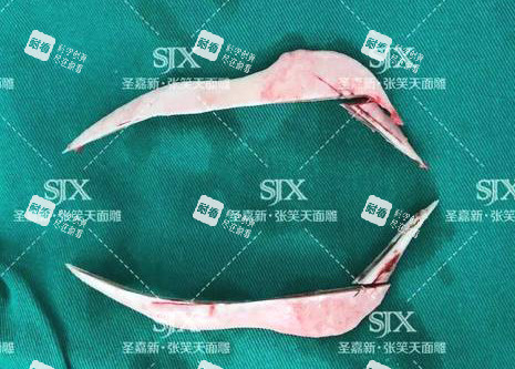 北京圣嘉新医疗美容医院张笑天下颌角手术截骨.jpg 北京圣嘉新医疗美容医院张笑天下颌角手术截骨.jpg