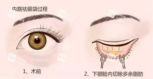 去眼袋手术.jpg 去眼袋手术.jpg