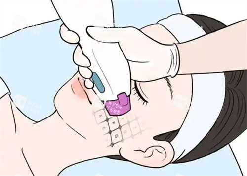 面部热玛吉卡通图片.jpg