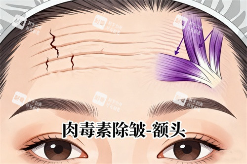抬头纹注射卡通图
