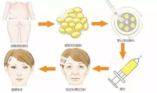 自体脂肪面部填充.jpg 自体脂肪面部填充.jpg
