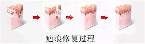 疤痕修复过程图 疤痕修复过程图
