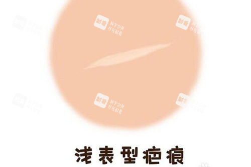 浅表型疤痕修复改善 浅表型疤痕修复改善