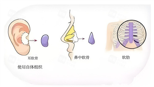 隆鼻耳中隔软骨体移植手术动画演示图.jpg 隆鼻耳中隔软骨体移植手术动画演示图.jpg