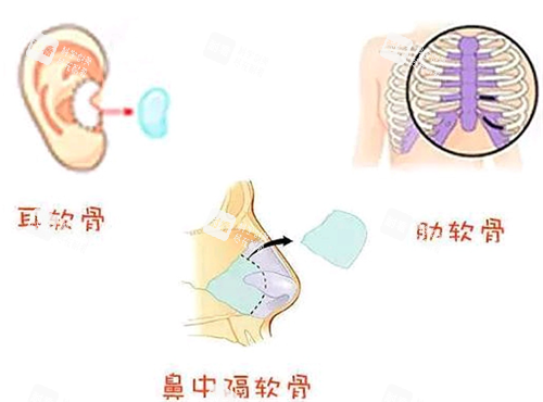 隆鼻手术.png 隆鼻手术.png