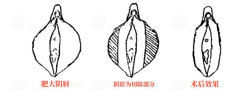 小阴唇肥大直接切除法演示动画图.jpg 小阴唇肥大直接切除法演示动画图.jpg