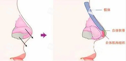 假体肋骨复合型隆鼻示意图.jpg 假体肋骨复合型隆鼻示意图.jpg