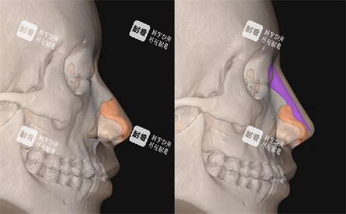 FITme3D鼻假体模拟隆鼻展示.jpg FITme3D鼻假体模拟隆鼻展示.jpg