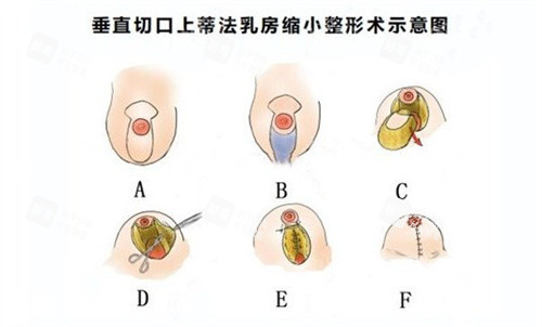 缩胸手术.jpg 缩胸手术.jpg