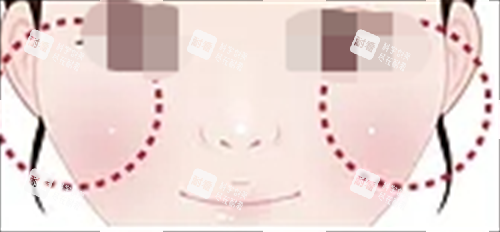 玻尿酸填充眼下填充.png 玻尿酸填充眼下填充.png