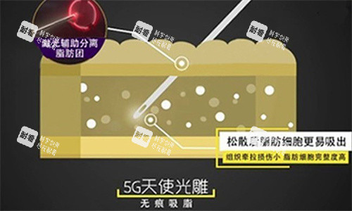 5G天使光雕吸脂 5G天使光雕吸脂