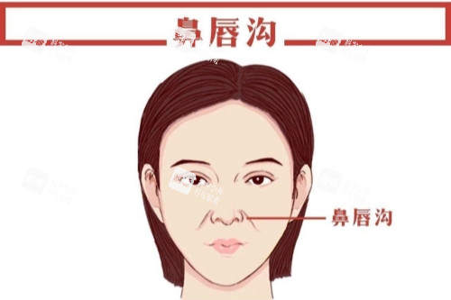 鼻唇沟卡通图.jpg 鼻唇沟卡通图.jpg