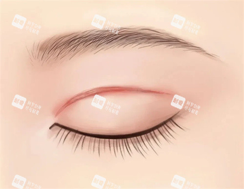 双眼皮的术后疤痕.jpg 双眼皮的术后疤痕.jpg