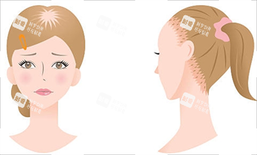 女生脱发类型 女生脱发类型