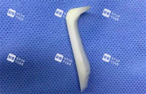 取出的隆鼻假体 取出的隆鼻假体
