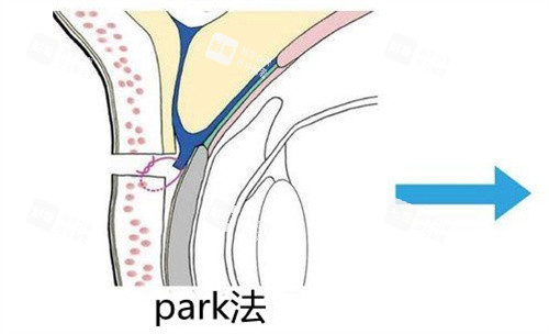 Park法双眼皮.jpg Park法双眼皮.jpg