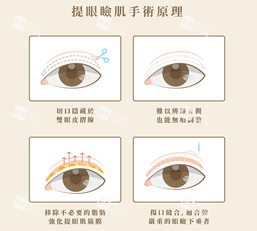 双眼皮失败修复提升眼肌手术.jpg 双眼皮失败修复提升眼肌手术.jpg