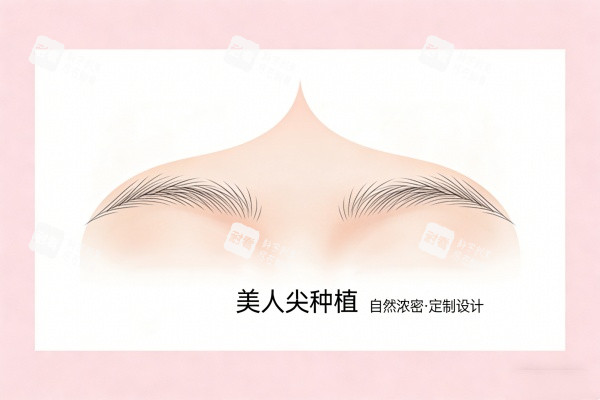 美人尖种植卡通图展示.jpg