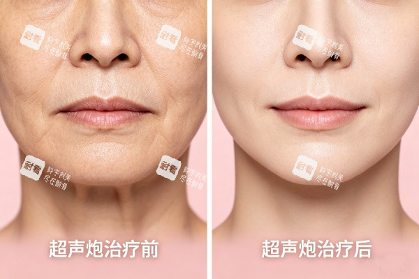 超声炮治疗前后对比图.jpg