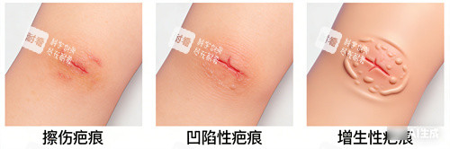 三种疤痕.jpg 三种疤痕.jpg
