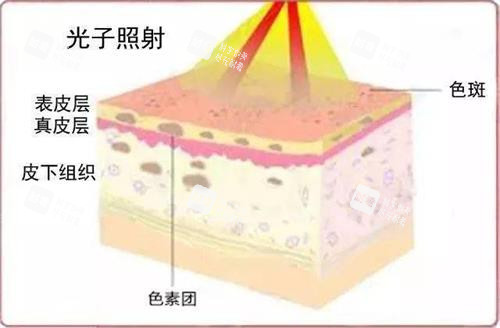光子嫩肤的示意图..jpeg 光子嫩肤的示意图..jpeg