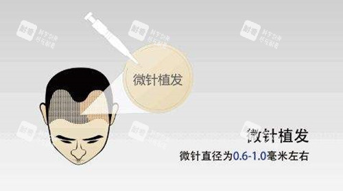 微针植发示意图.jpg 微针植发示意图.jpg