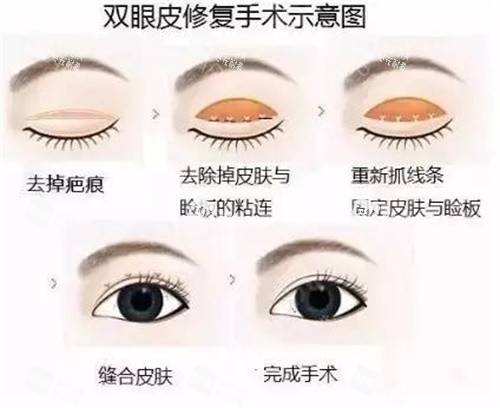 双眼皮修复示意图.jpg 双眼皮修复示意图.jpg