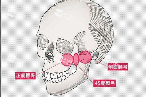 颧骨颧弓大概位置示意图.jpg 颧骨颧弓大概位置示意图.jpg