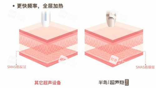 半岛超声炮和普通超声.jpg 半岛超声炮和普通超声.jpg