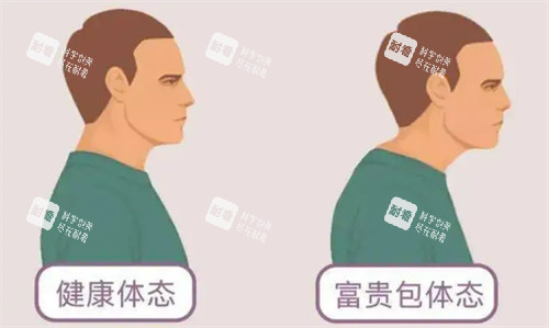健康体态和富贵包体态对比 健康体态和富贵包体态对比