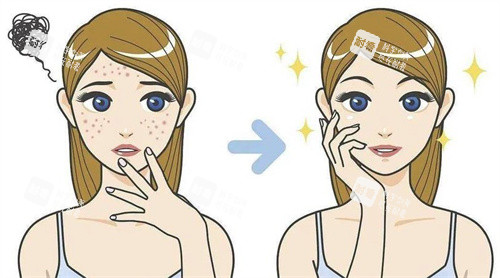 去痘印卡通图