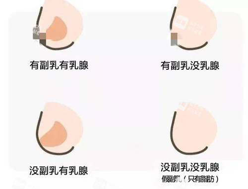不同类型副乳卡通示意图 不同类型副乳卡通示意图
