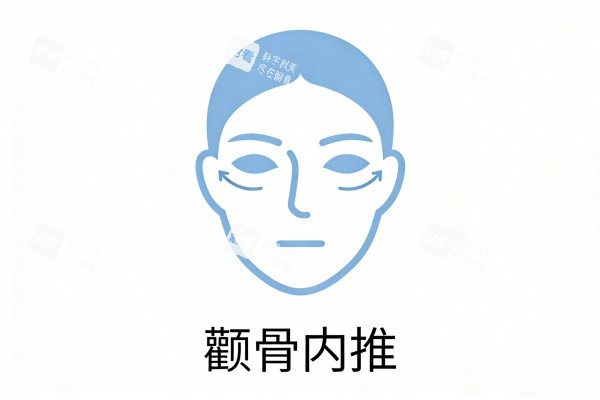 颧骨内推图片展示.jpg 颧骨内推图片展示.jpg