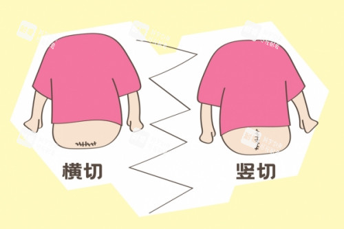剖腹产横切竖切卡通图