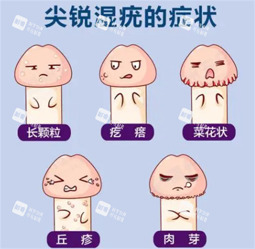 阴茎尖锐湿疣 阴茎尖锐湿疣