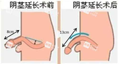 阴茎增长手术前后对比动画图 阴茎增长手术前后对比动画图