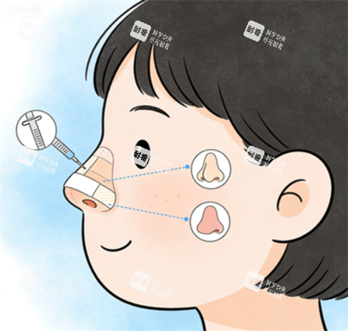 鼻修复的手术部位.png 鼻修复的手术部位.png
