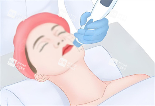 面部热玛吉.jpg