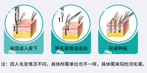 植发过程示意图片.jpg 植发过程示意图片.jpg