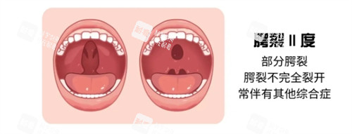二度唇腭裂示意图