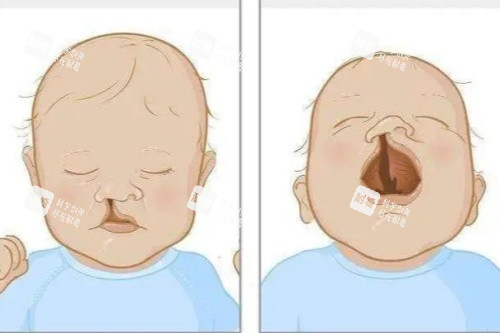 唇腭裂卡通图