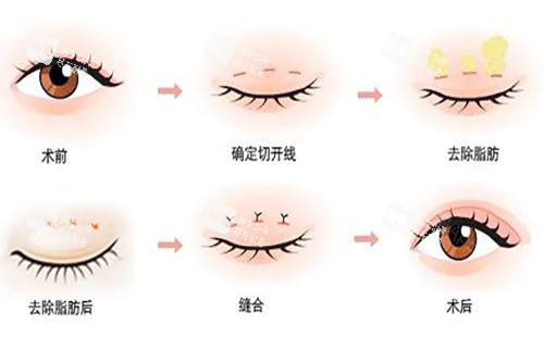 切开式双眼皮过程.jpg 切开式双眼皮过程.jpg