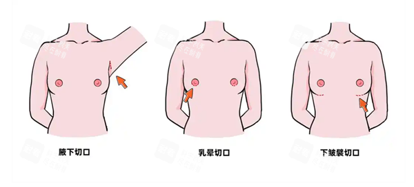 隆胸手术切口图.png 隆胸手术切口图.png