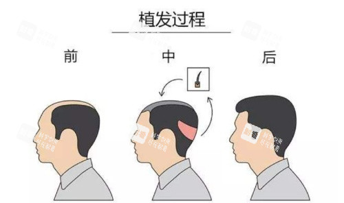 头顶加密过程示意图.jpg 头顶加密过程示意图.jpg