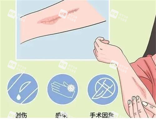疤痕增生因素图 疤痕增生因素图
